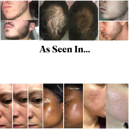 Cenvia™  Micro-Needle Derma Roller